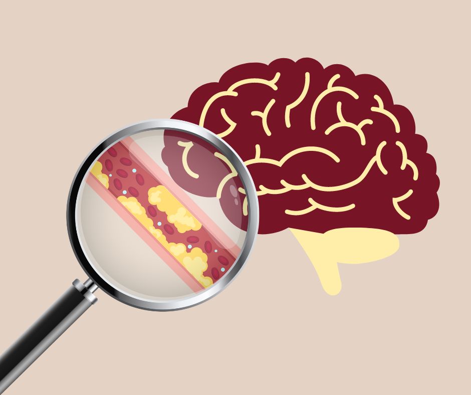 How Vascular Dementia and Stroke are Connected
